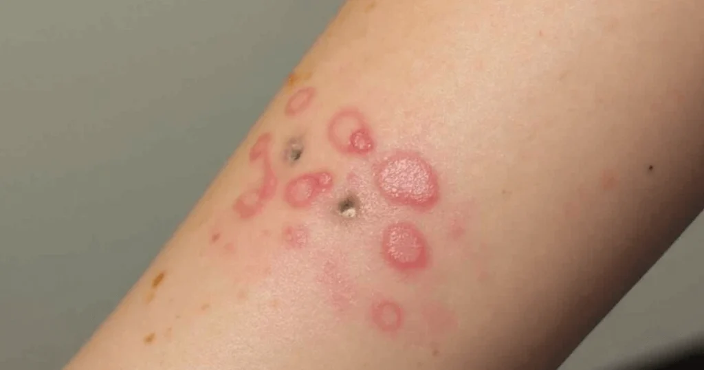 laser tattoo removal blisters
